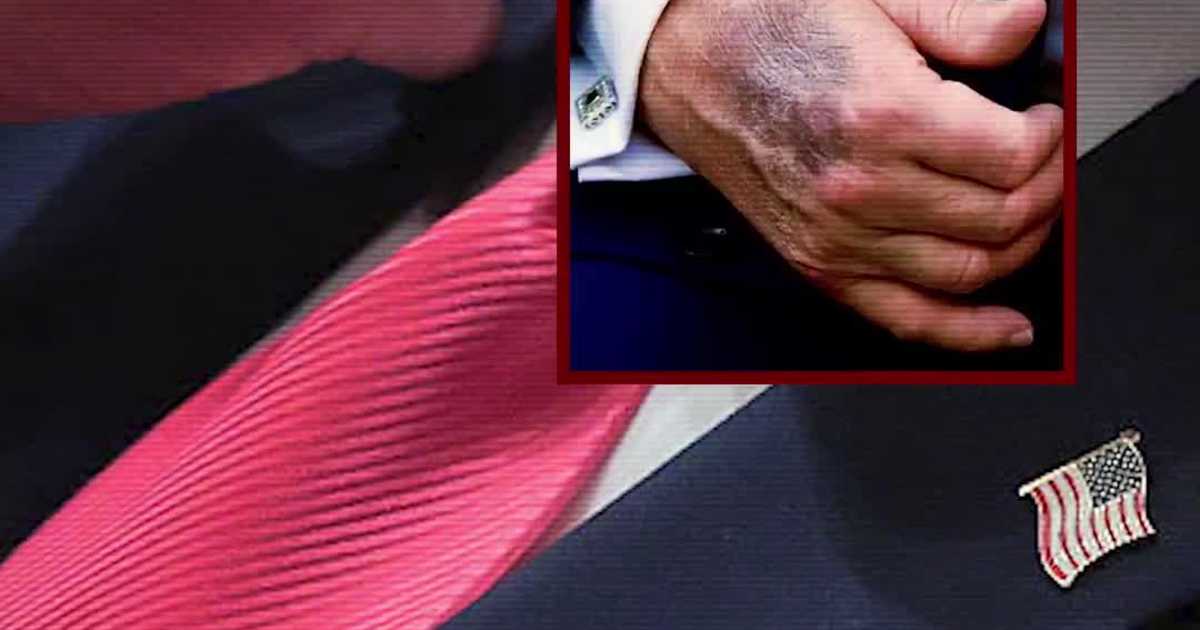 Leavitt Addresses Questions Over Trump’s Bruised Hand